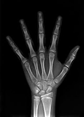 carpal